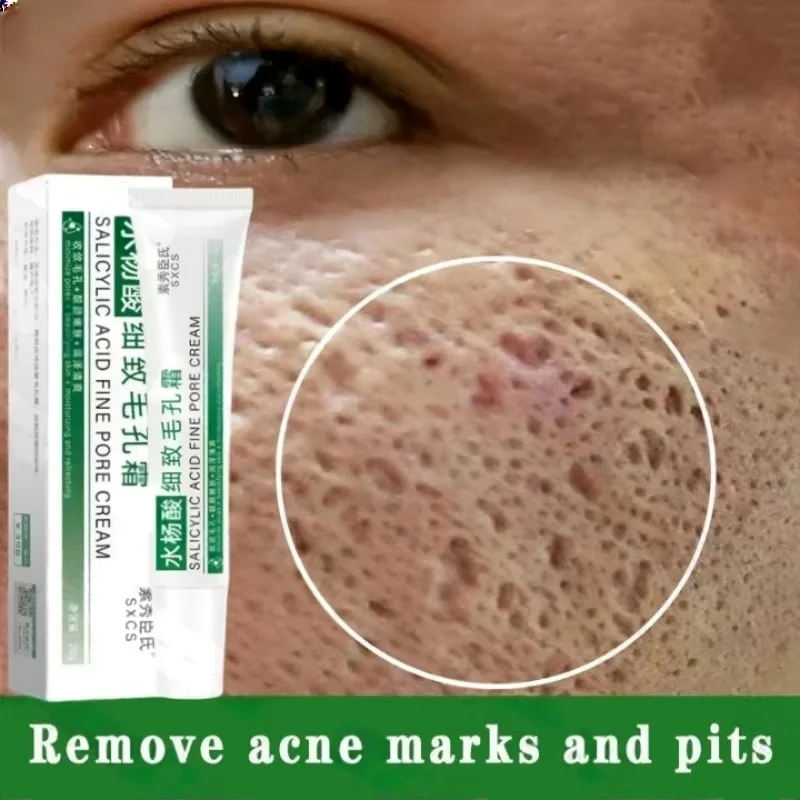 Salicylzuur Porie Clearing Cre - Azelaic Acid Cream recensie en prijs