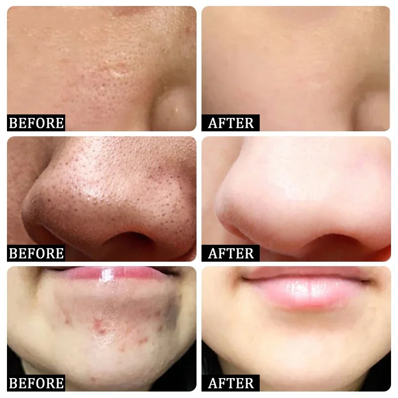 Salicylzuur Porie Clearing Cre - Azelaic Acid Cream recensie en prijs