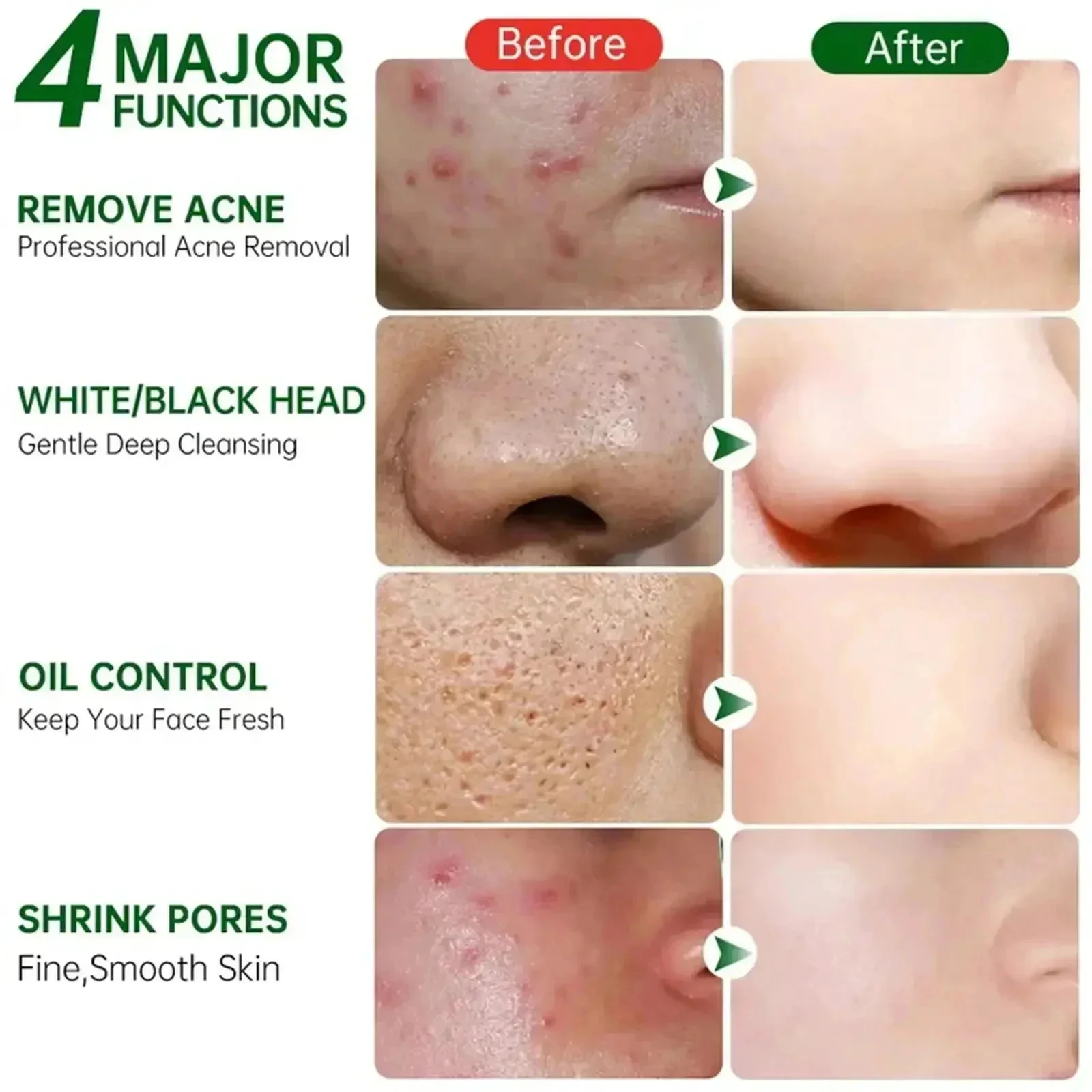 Salicylzuur Porie Clearing Cre - Azelaic Acid Cream recensie en prijs
