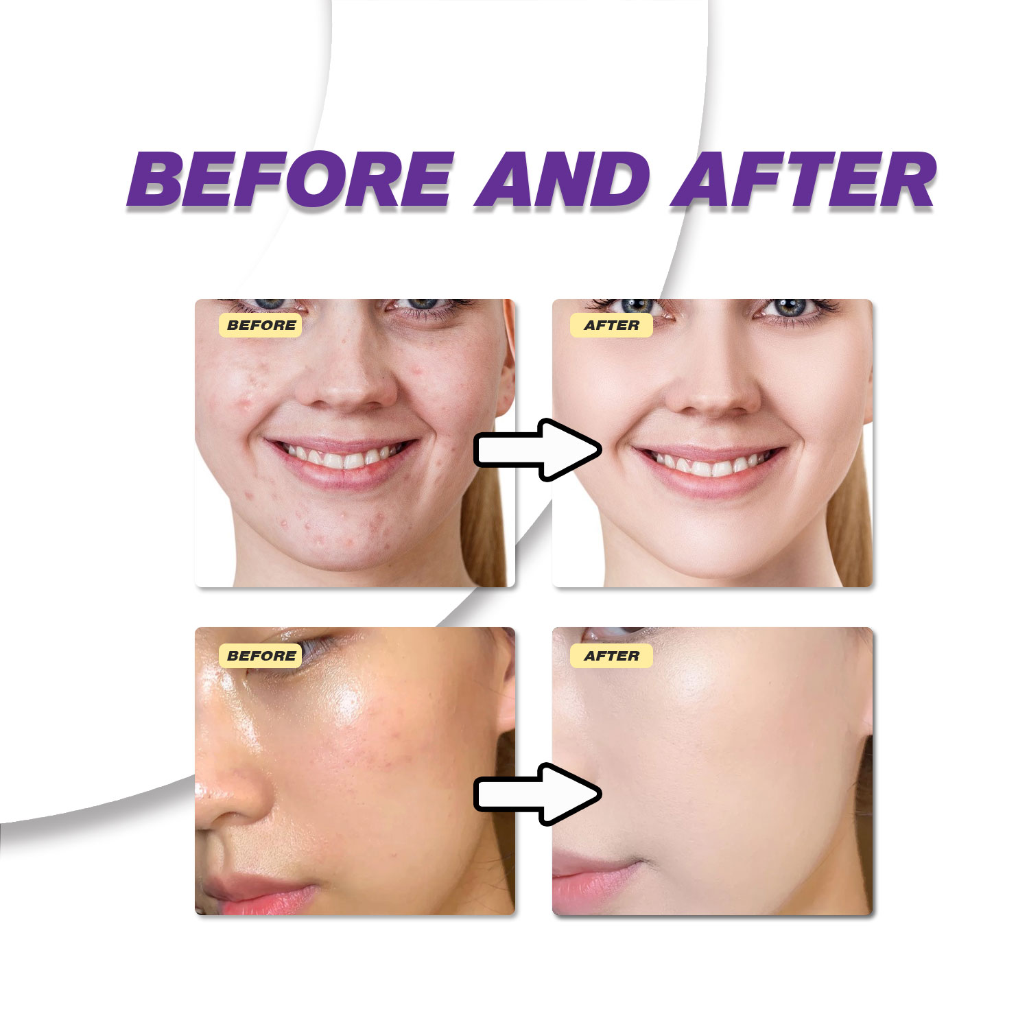Milde Azelaïnezuurcrème verbet - Azelaic Acid Cream recensie en prijs