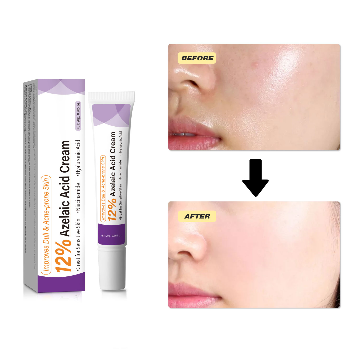 Milde Azelaïnezuurcrème verbet - Azelaic Acid Cream recensie en prijs